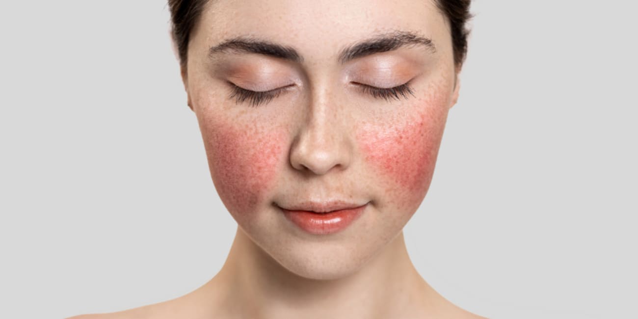 Що таке купероз і як зменшити його прояви на обличчі