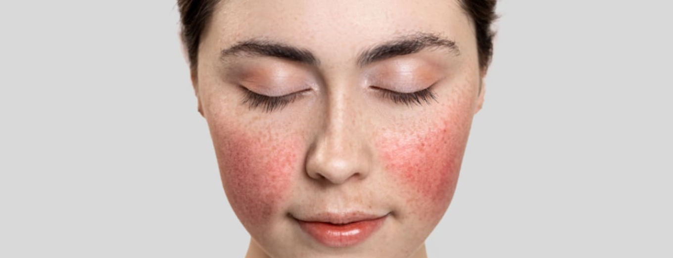 Что такое купероз и как уменьшить его проявления на лице Что такое купероз и как уменьшить его проявления на лице