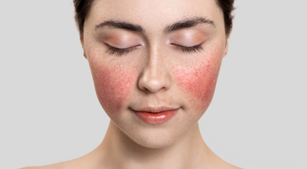 Что такое купероз и как уменьшить его проявления на лице