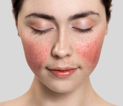Что такое купероз и как уменьшить его проявления на лице