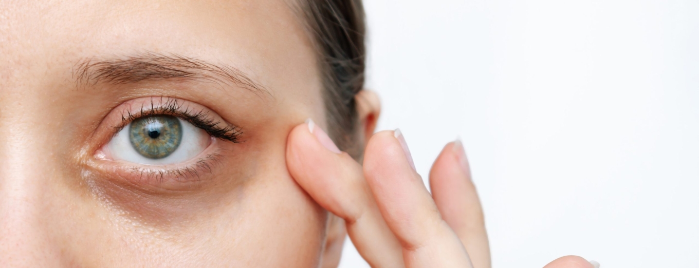 Как избавиться от темных кругов под глазами?