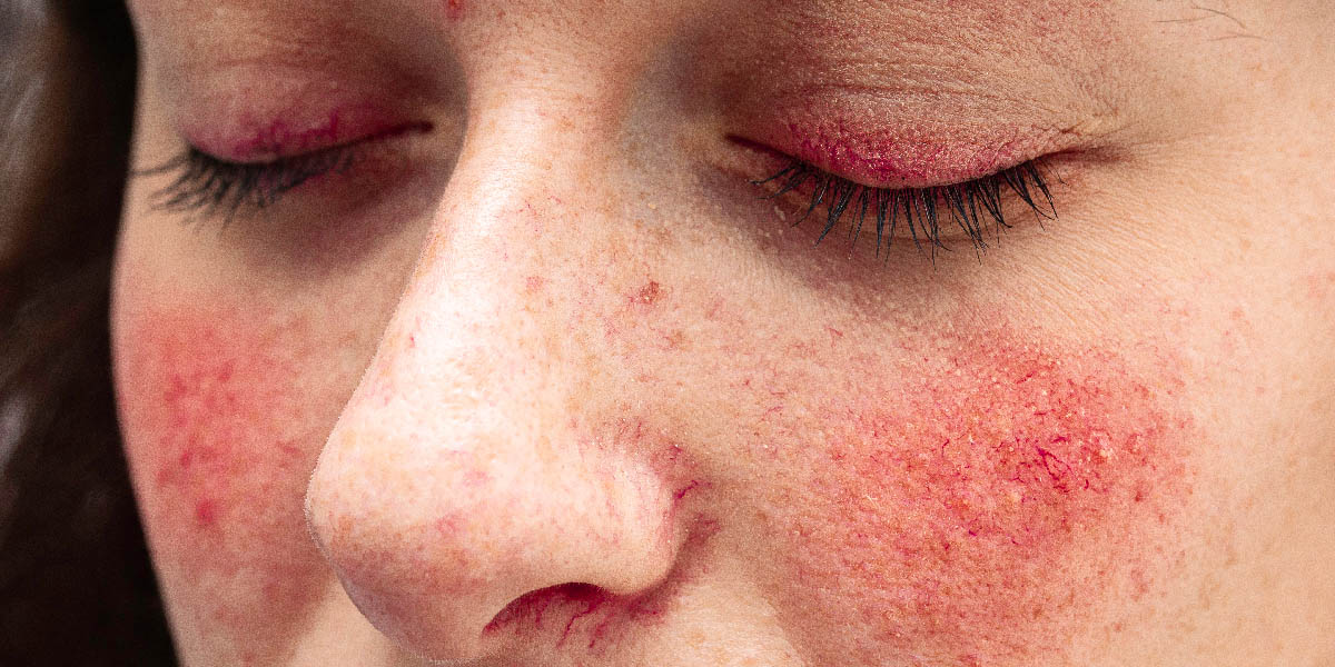 причини куперозу на обличчі