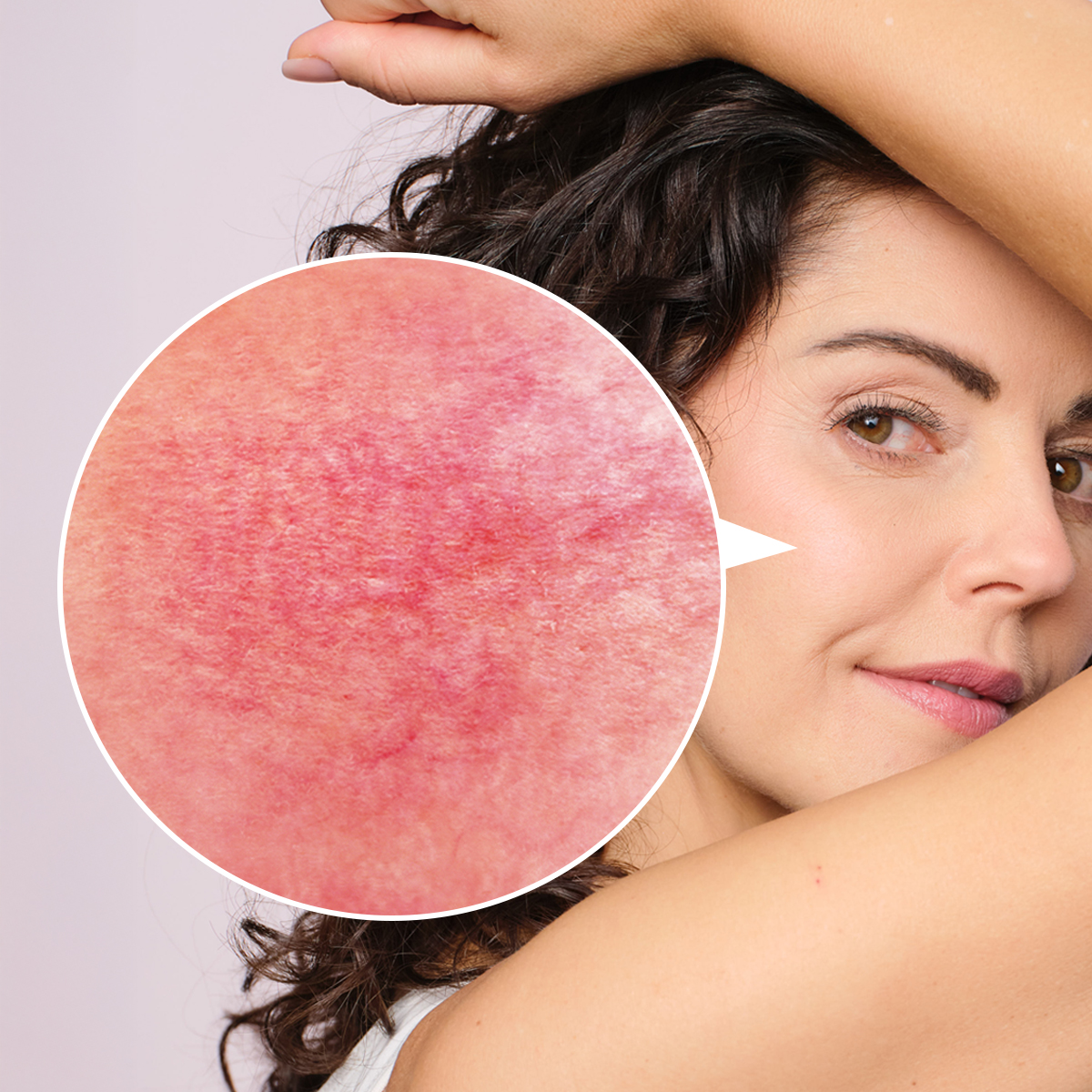 как лечить купероз на лице